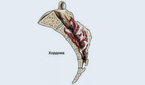 Хондрома позвоночника